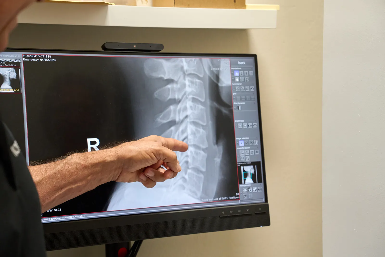Clinician reviewing a spinal x-ray to locate a pinched nerve at Novaré Injury Care
