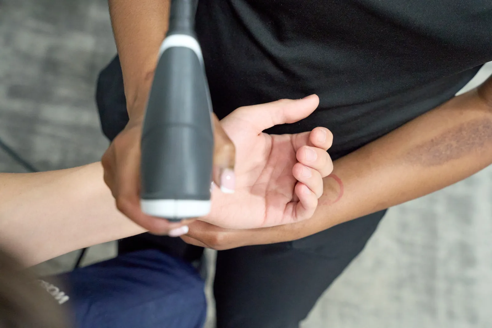 Shockwave therapy treatment at Novaré Injury Care